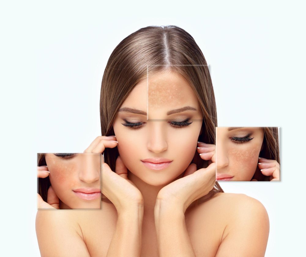 Melasma vs hyperpigmentation treatment — ORA Skin & Hair Clinics, Hyderabad