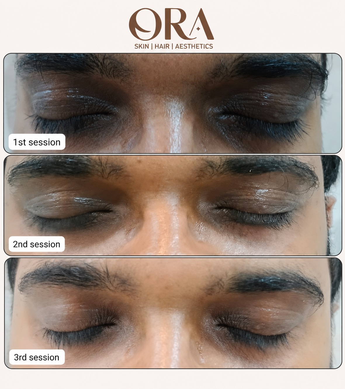 Dark circles and periorbital pigmentation treatment progress across 3 sessions at ORA Skin Clinics, Hyderabad