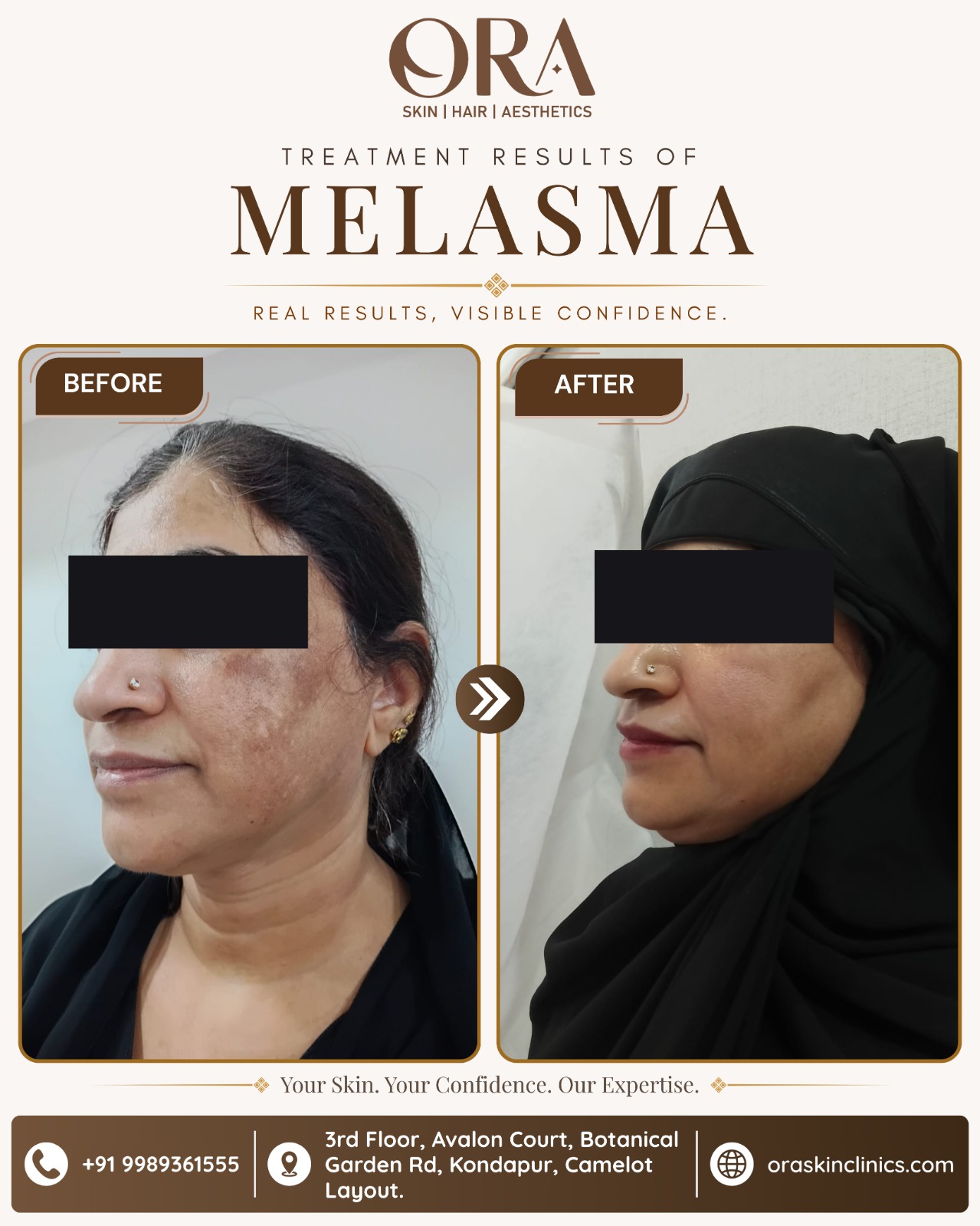 Melasma treatment before and after — significant reduction in facial pigmentation after 4 sessions at ORA Skin Clinics, Kondapur, Hyderabad