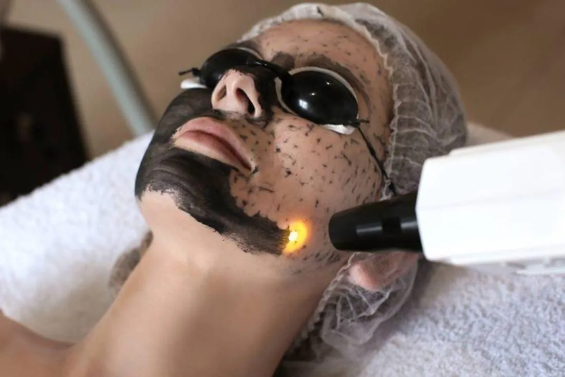 Carbon laser facial Hollywood peel Hyderabad Kondapur — Ora Skin Clinics