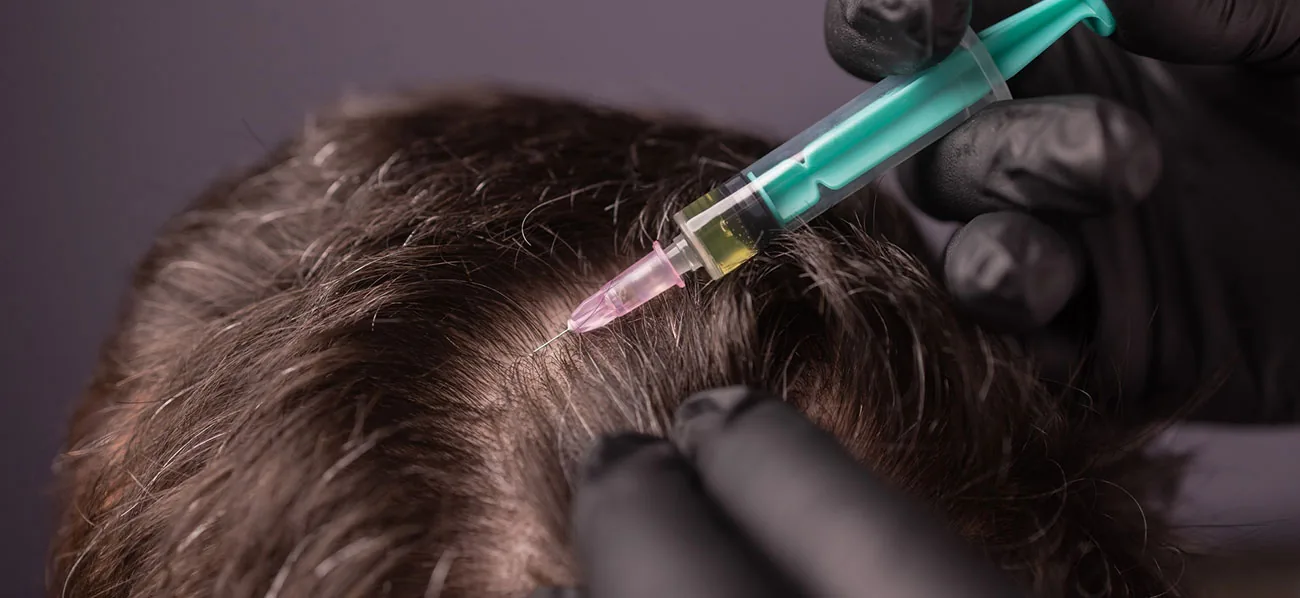 Exosomes hair treatment at Ora Skin Clinics Hyderabad