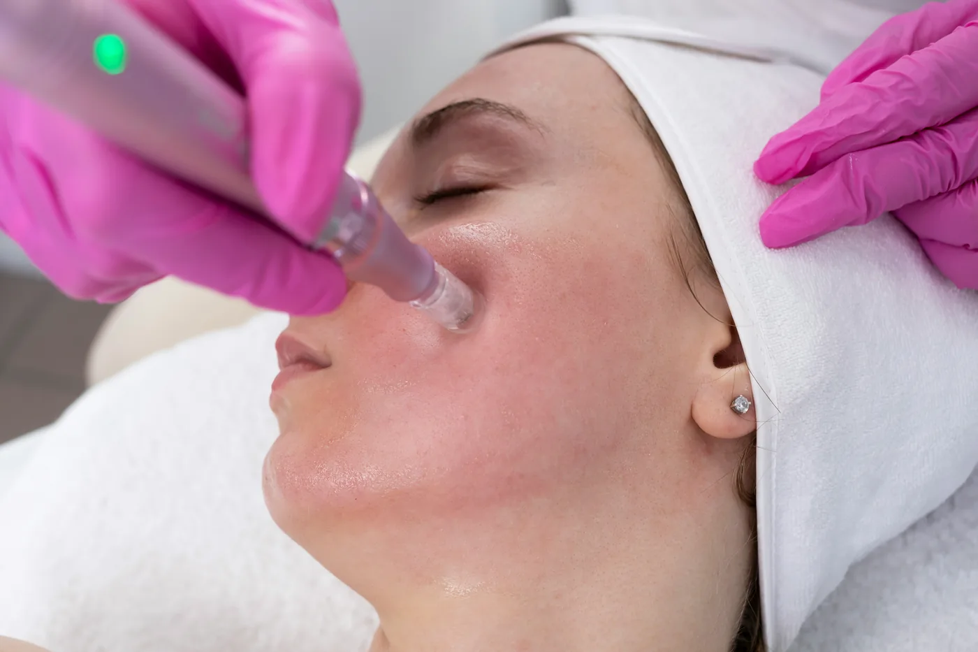 Mesotherapy treatment in Hyderabad Kondapur — Ora Skin Clinics