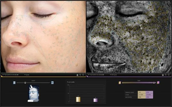 Pigmentation treatment in Hyderabad Kondapur — Ora Skin Clinics
