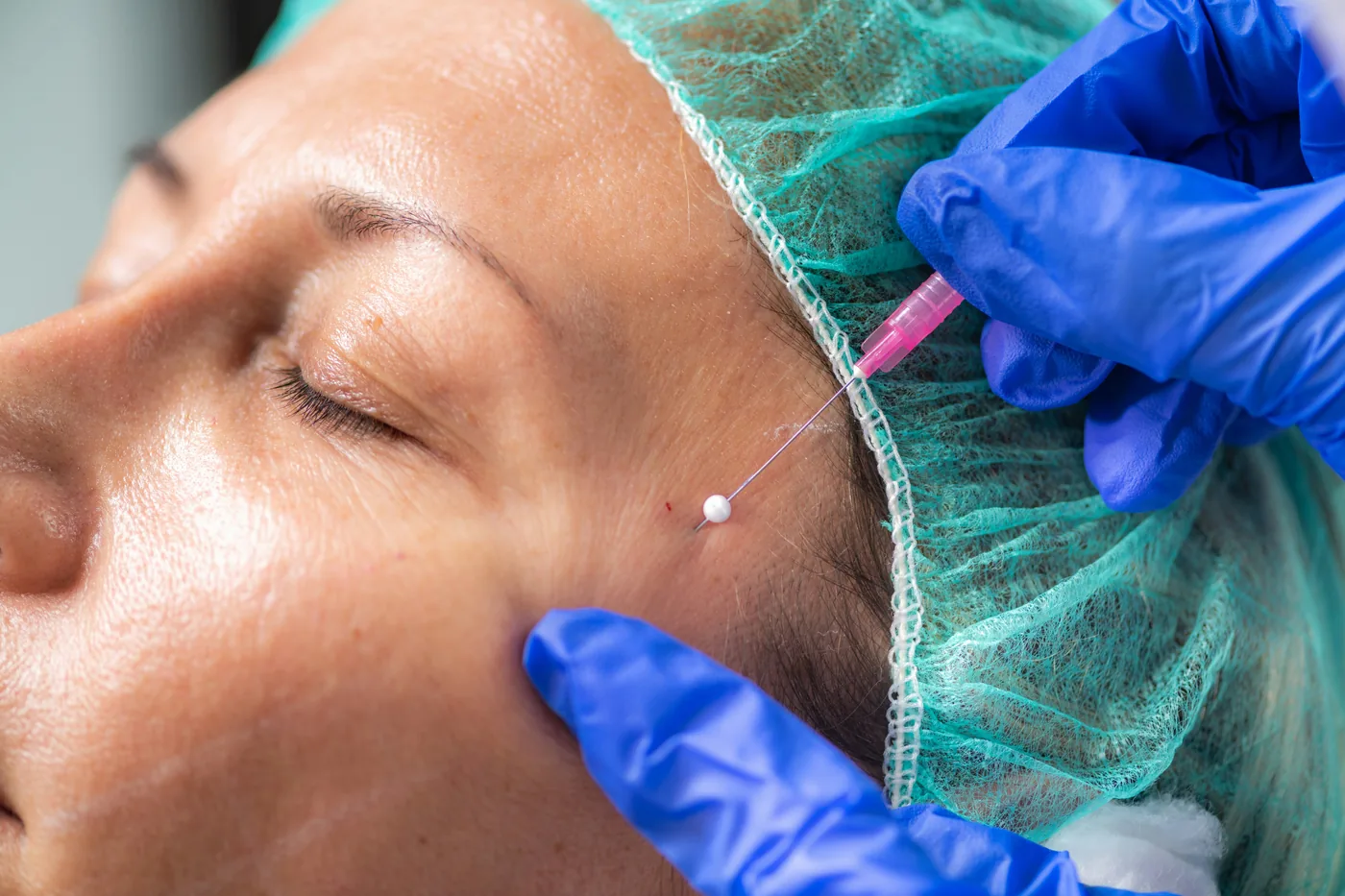 Thread lift treatment in Hyderabad Kondapur — Ora Skin Clinics